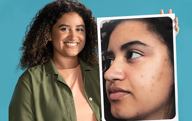 Proactiv customer holding an earlier close-up photo of her skin