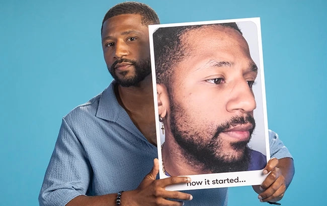 Proactiv customer holding an earlier close-up photo of his skin