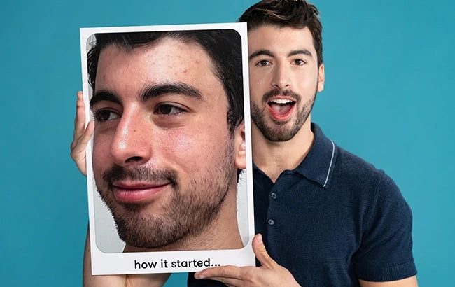 Proactiv customer holding an earlier close-up photo of his skin