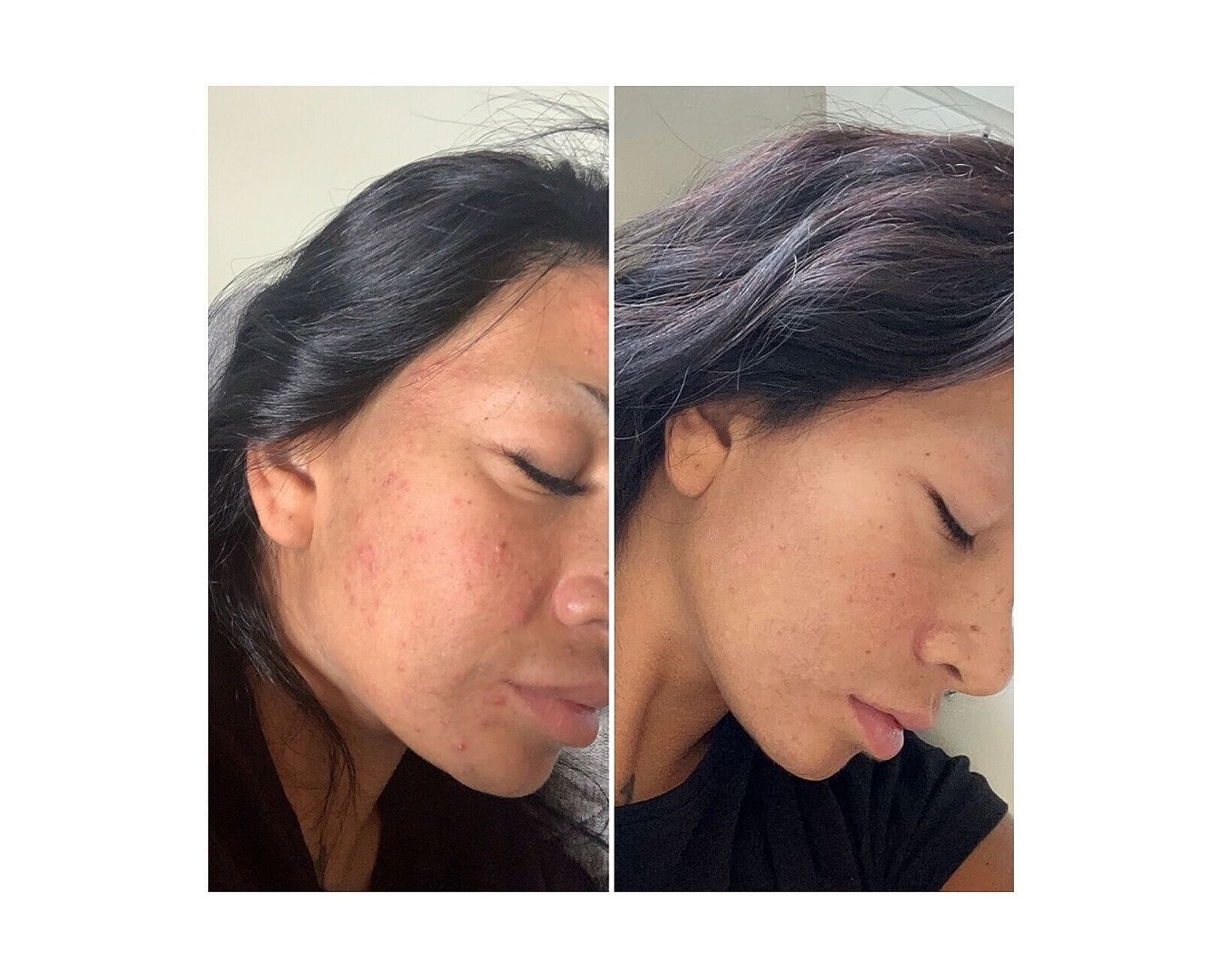 Alejandra's side-by-side photos: cheek bumps and texture on the left, visibly smoother skin on the right