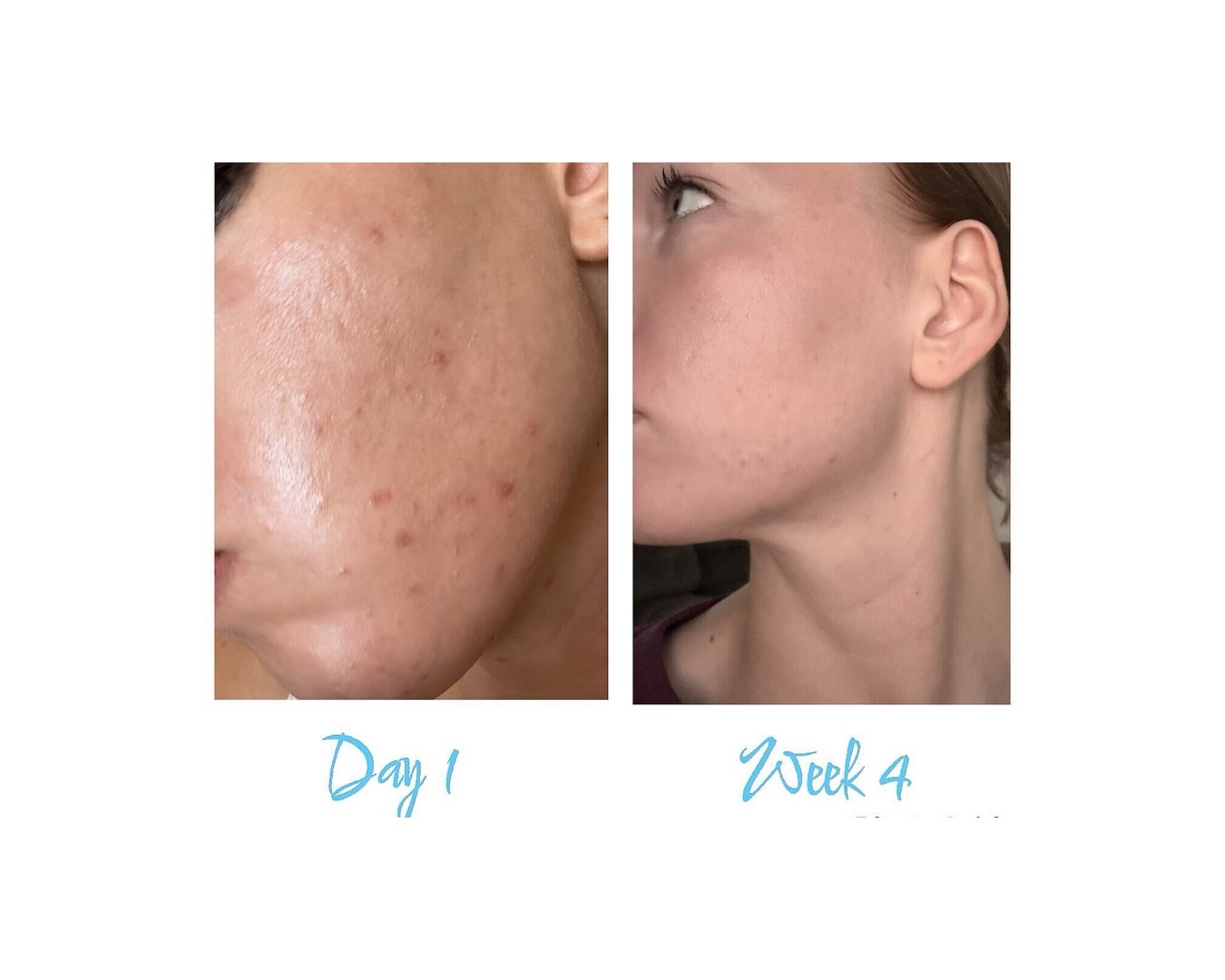 Ashley's side-by-side photos: cheek breakouts labeled day 1, visibly clearer skin labeled week 4