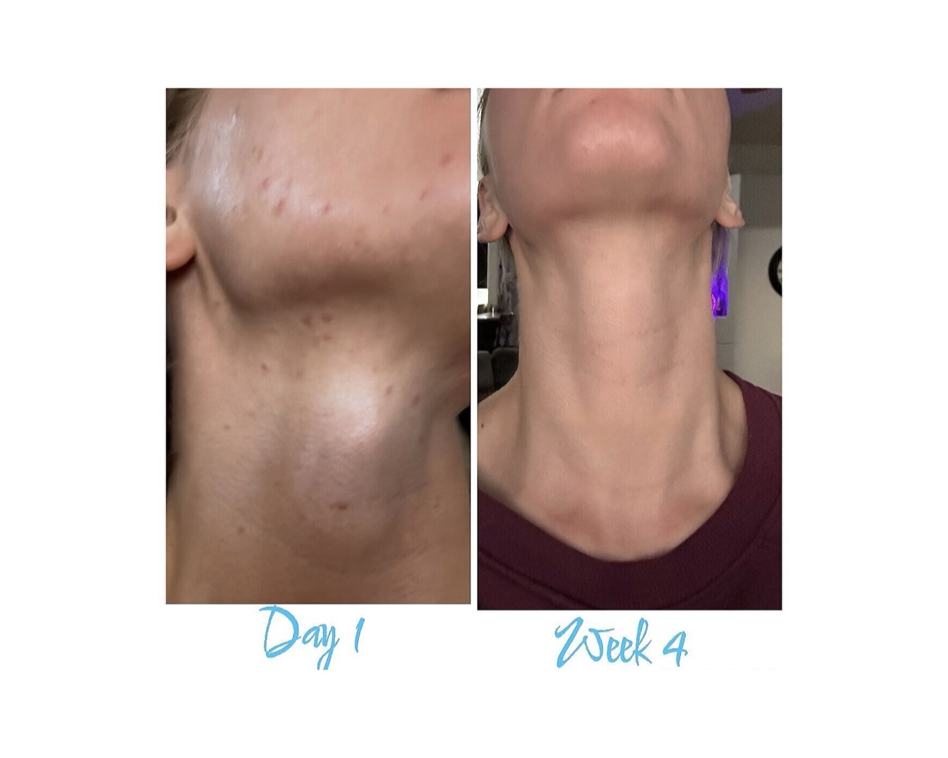 Ashley's side-by-side photos: neck and jawline breakouts labeled day 1, clearer skin labeled week 4